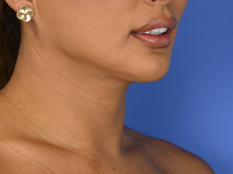 Tracheal Shave Before & After Image