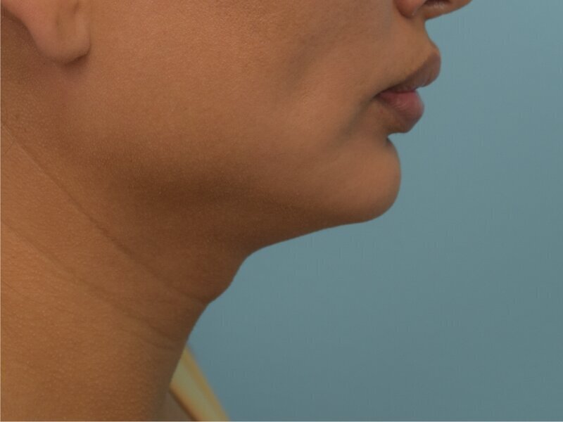 Tracheal Shave Before & After Image
