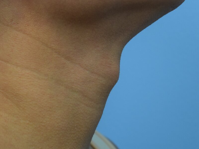 Tracheal Shave Before & After Image