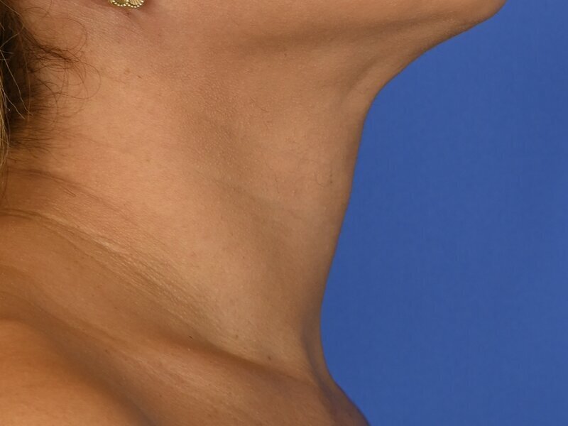 Tracheal Shave Before & After Image