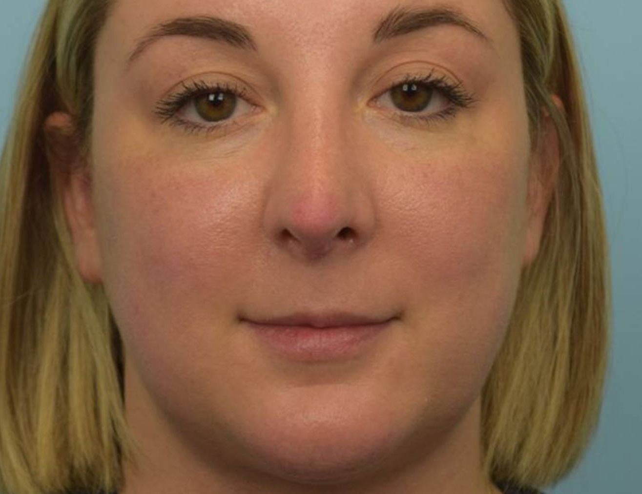 Revision Rhinoplasty Before & After Image