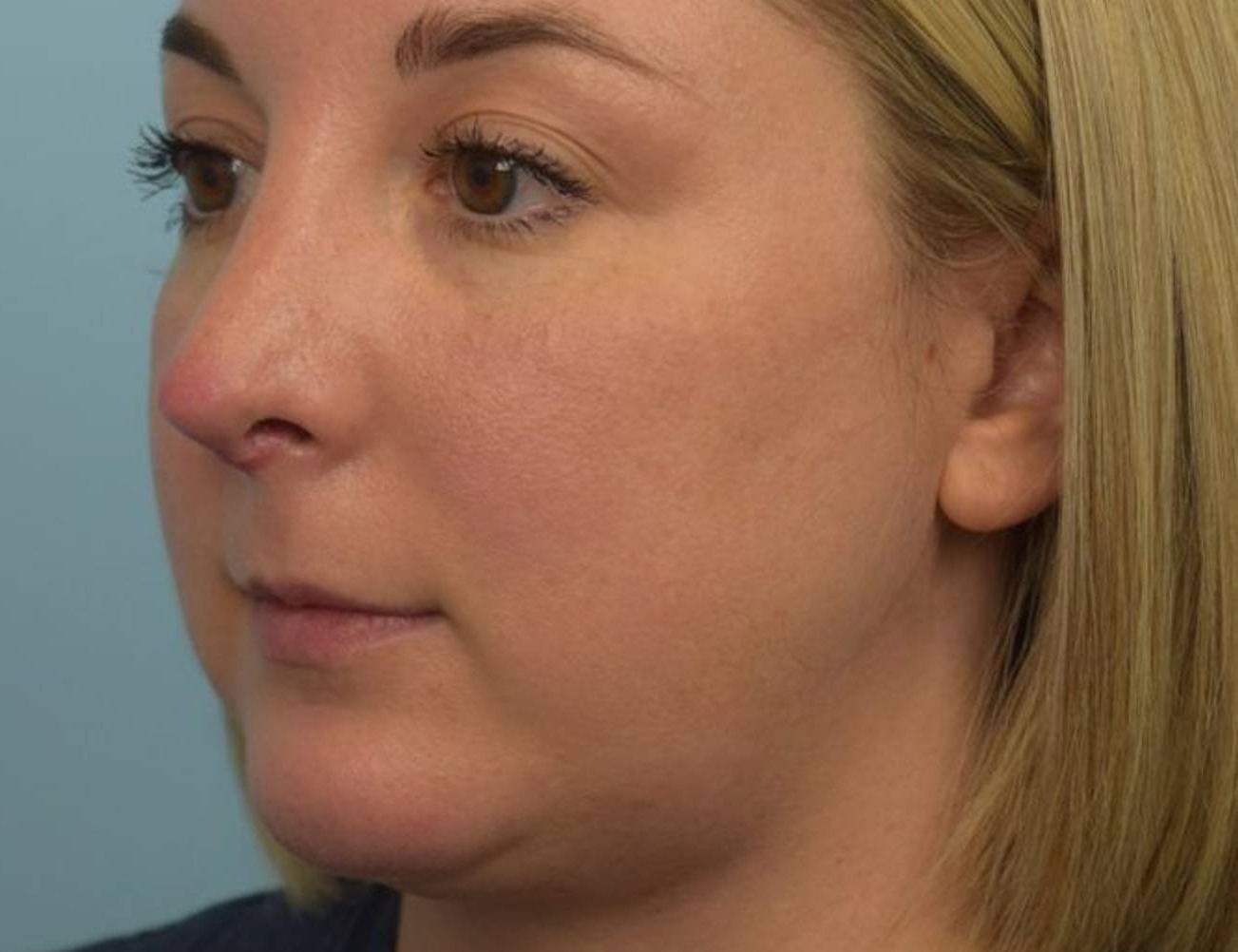 Revision Rhinoplasty Before & After Image