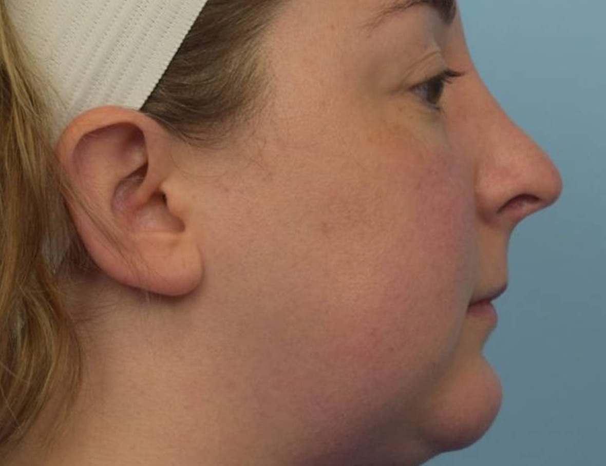 Revision Rhinoplasty Before & After Image