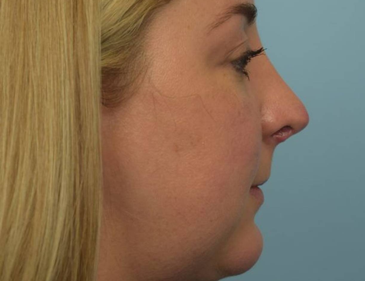 Revision Rhinoplasty Before & After Image