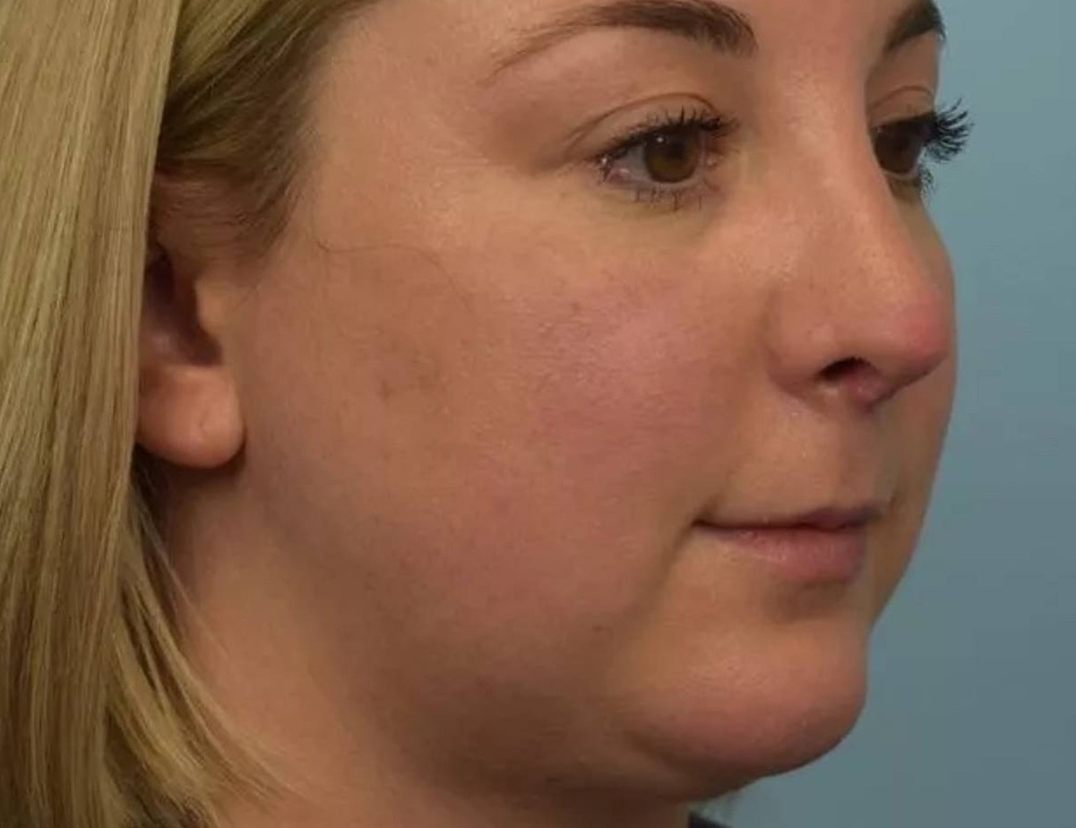 Revision Rhinoplasty Before & After Image
