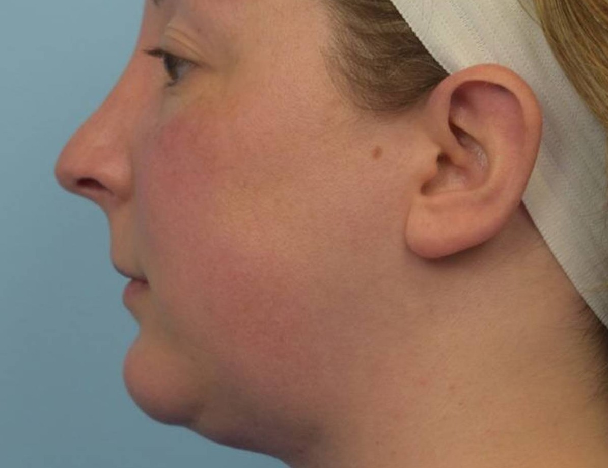 Revision Rhinoplasty Before & After Image