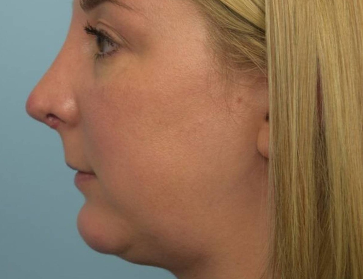 Revision Rhinoplasty Before & After Image