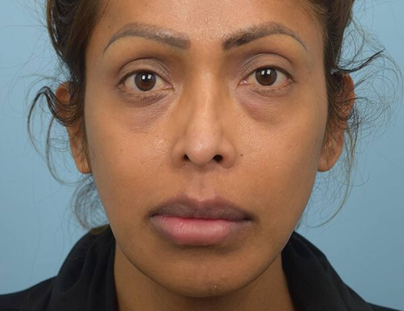 Revision Rhinoplasty Before & After Image