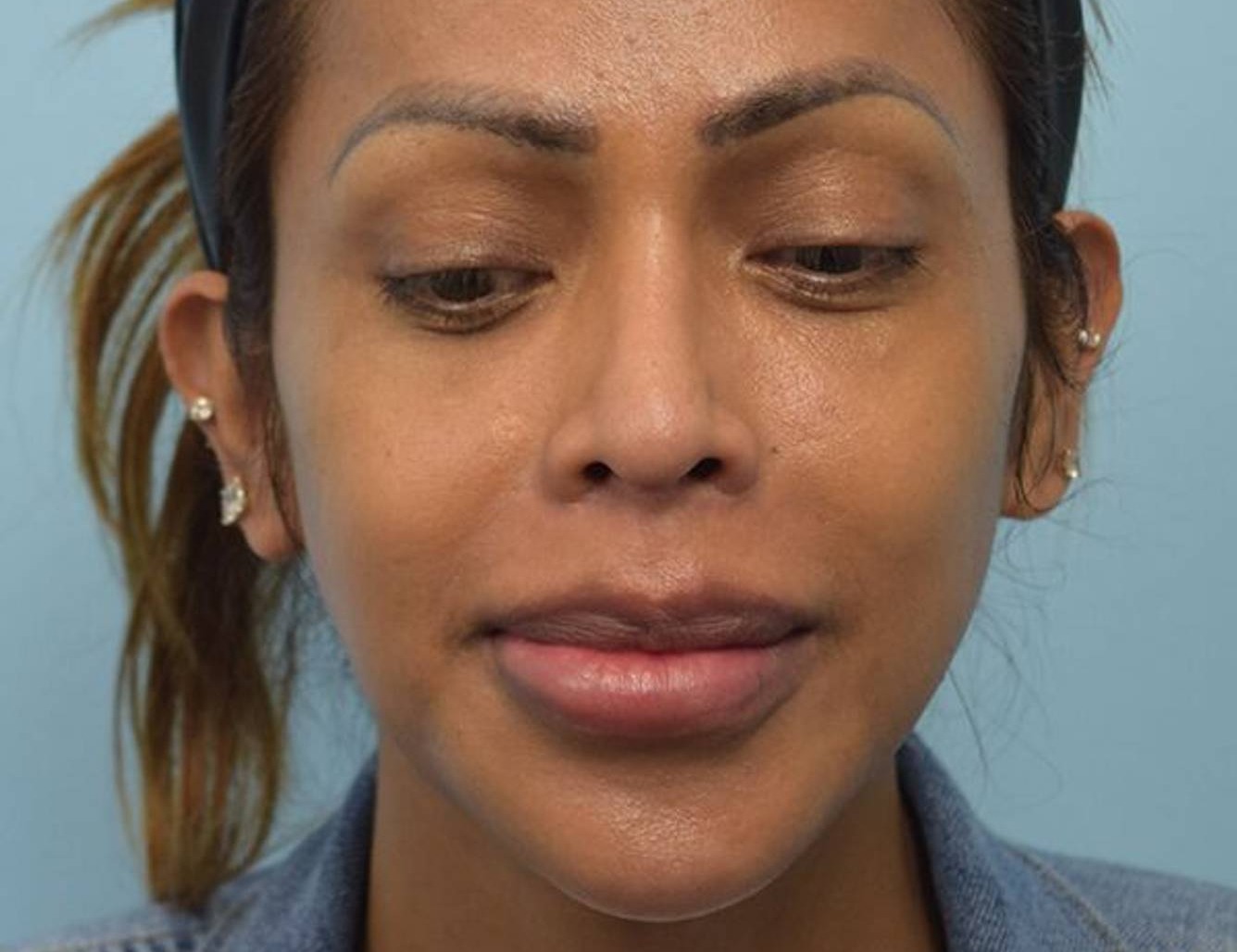 Revision Rhinoplasty Before & After Image