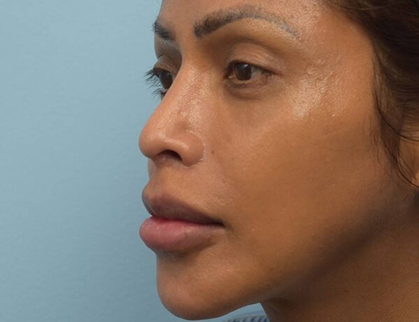 Revision Rhinoplasty Before & After Image