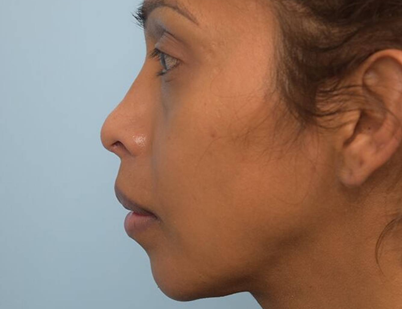 Revision Rhinoplasty Before & After Image