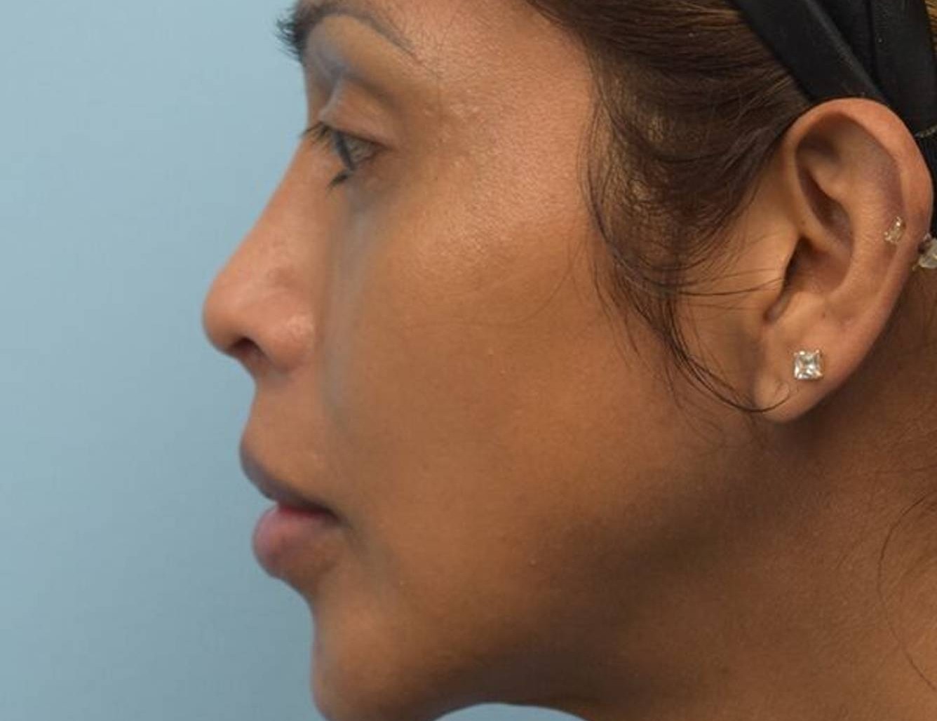 Revision Rhinoplasty Before & After Image