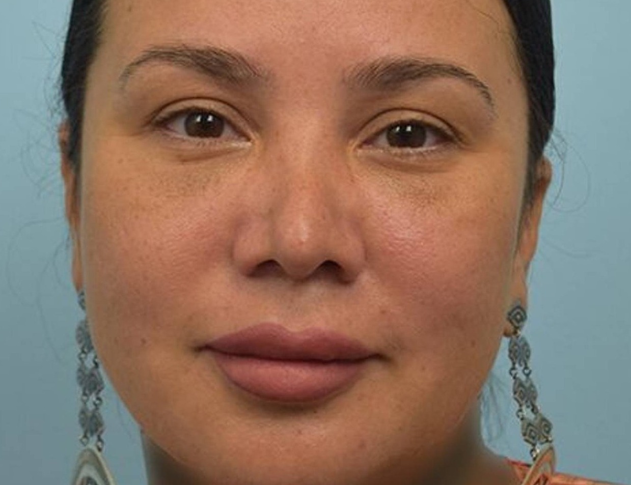 Revision Rhinoplasty Before & After Image