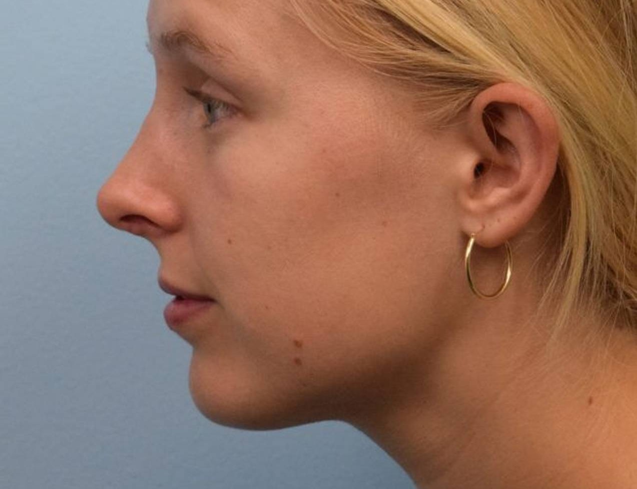 Revision Rhinoplasty Before & After Image