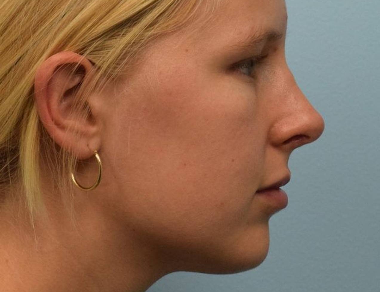 Revision Rhinoplasty Before & After Image