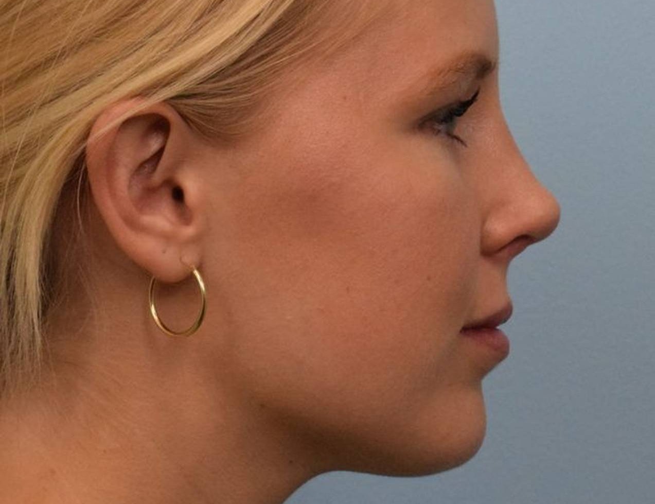 Revision Rhinoplasty Before & After Image