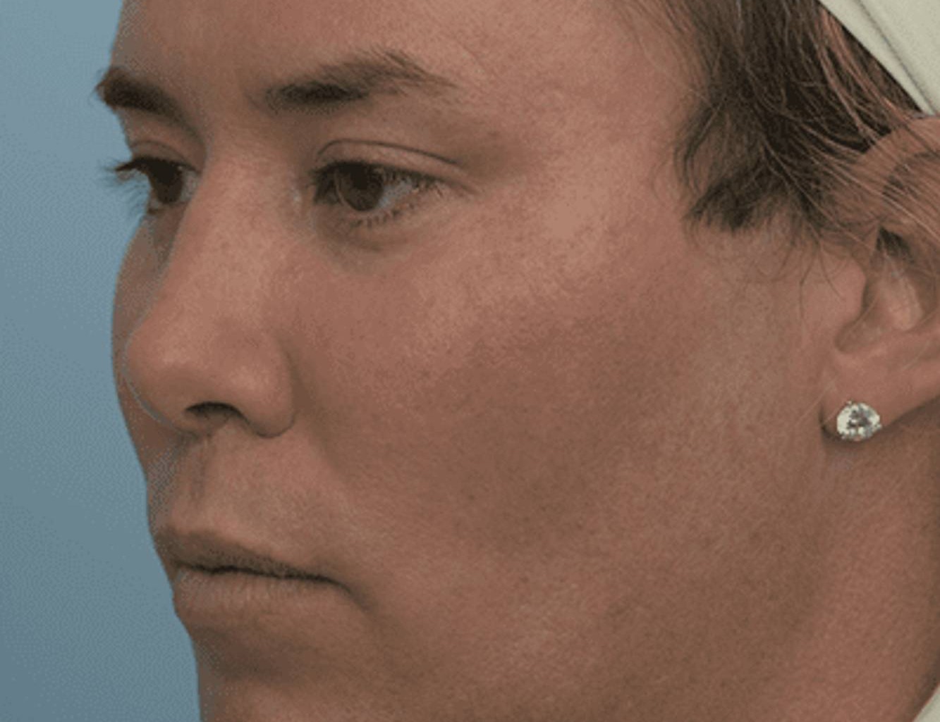 Revision Rhinoplasty Before & After Image