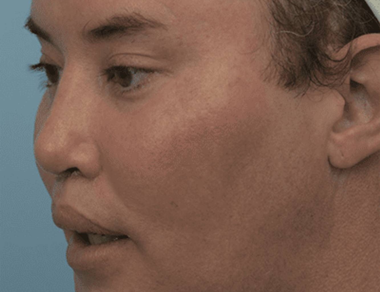 Revision Rhinoplasty Before & After Image