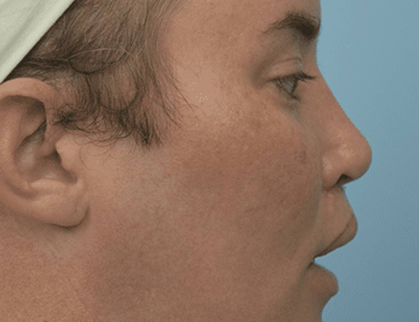 Revision Rhinoplasty Before & After Image