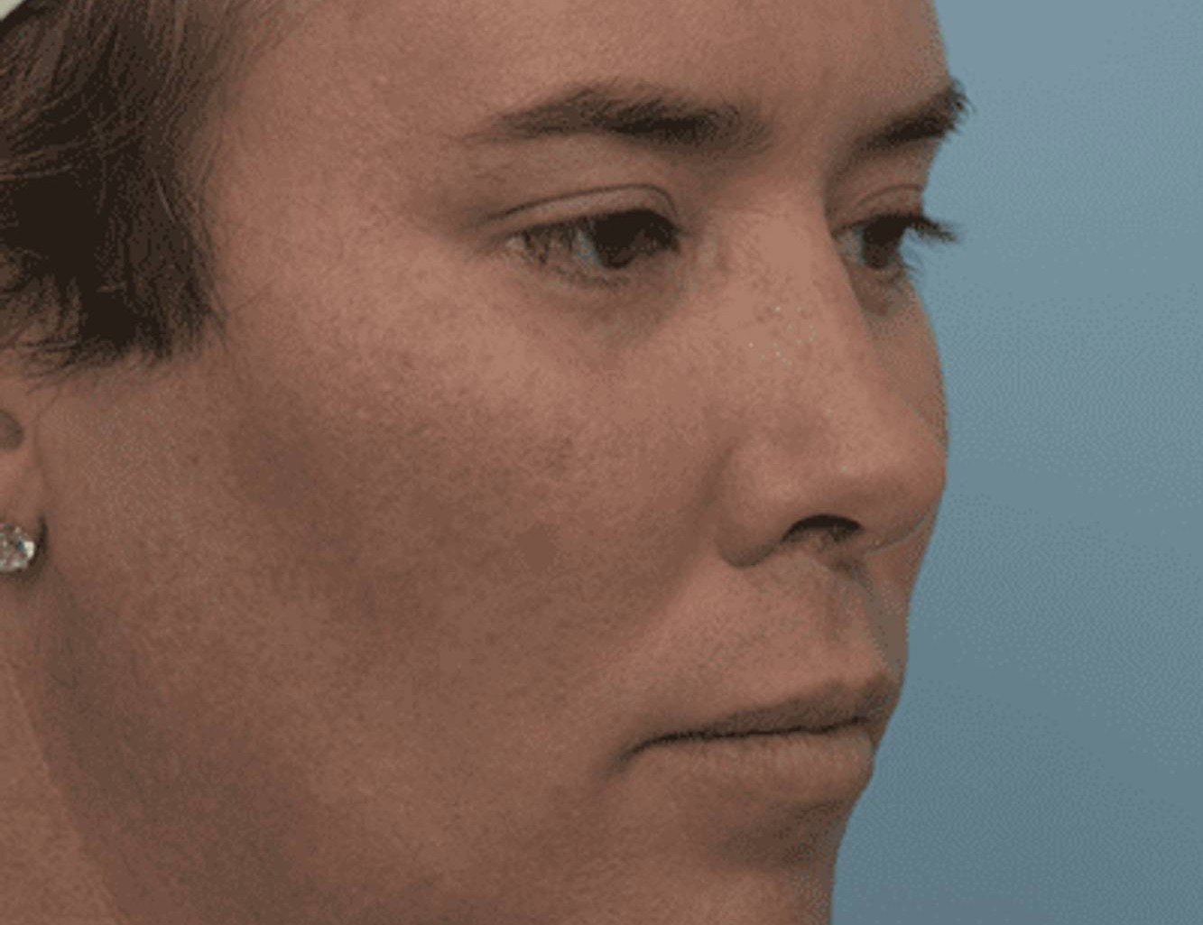 Revision Rhinoplasty Before & After Image