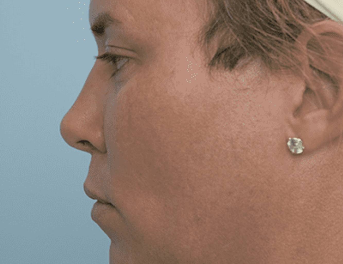 Revision Rhinoplasty Before & After Image