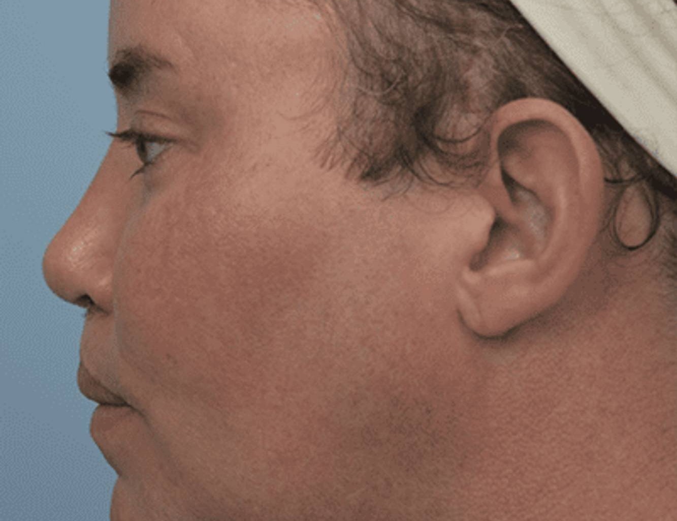 Revision Rhinoplasty Before & After Image