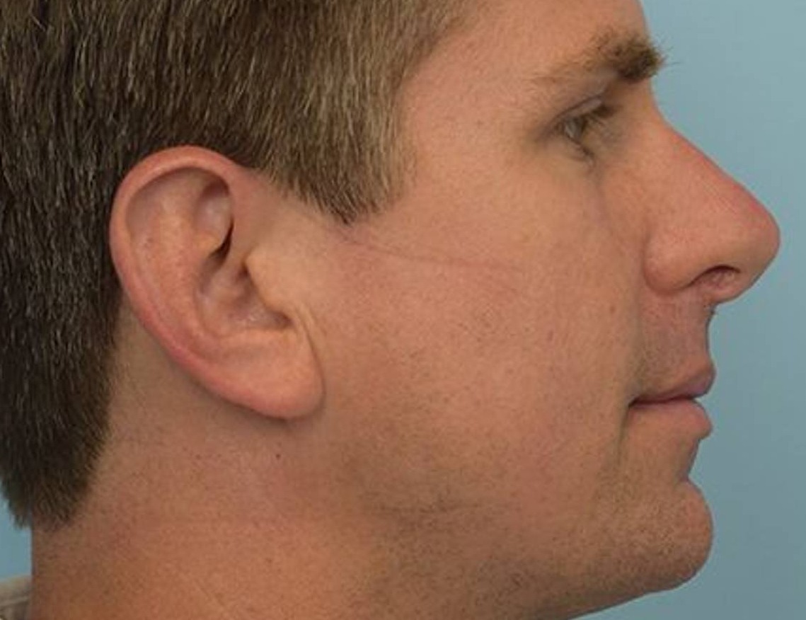 Revision Rhinoplasty Before & After Image