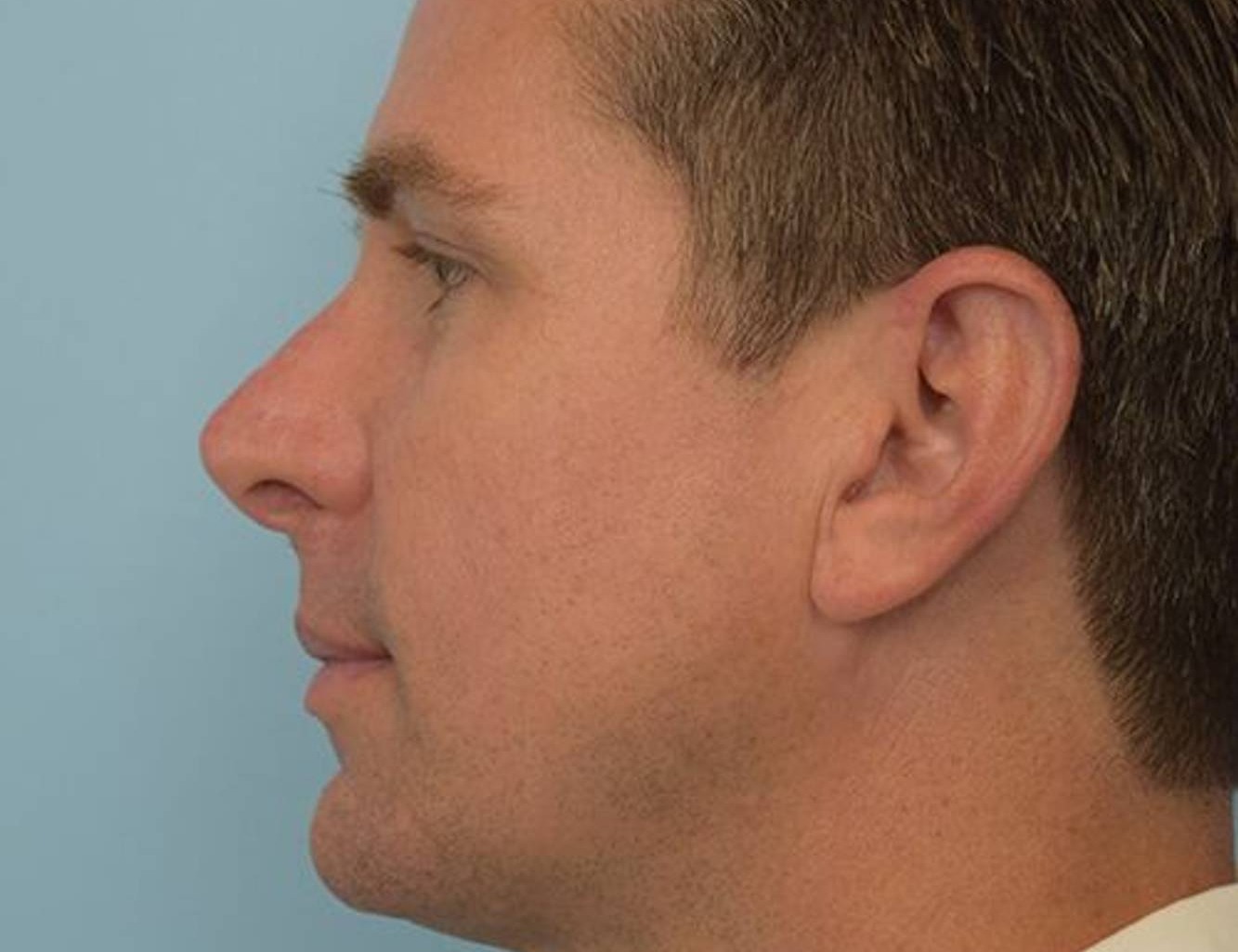 Revision Rhinoplasty Before & After Image