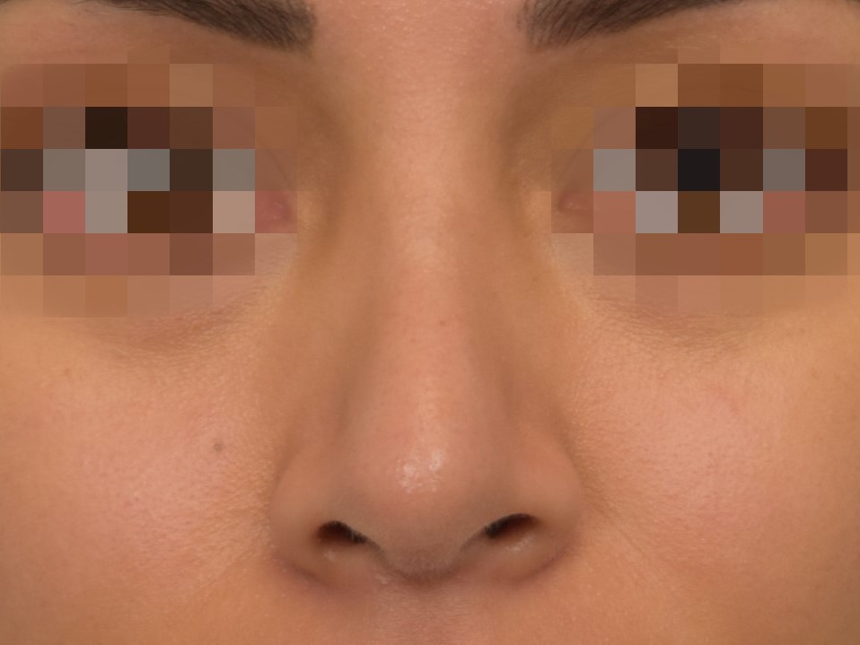 Revision Rhinoplasty Before & After Image