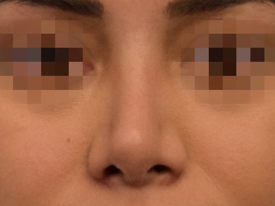 Revision Rhinoplasty Before & After Image