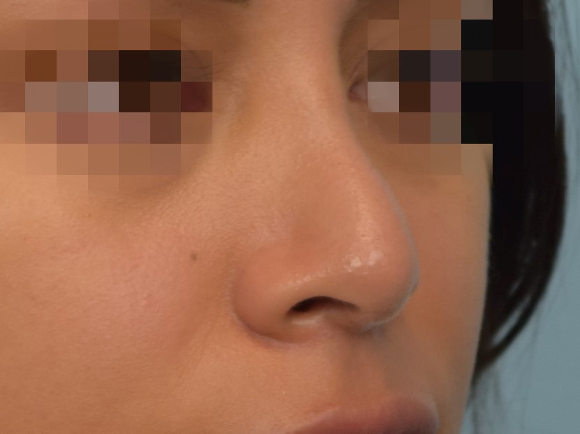 Revision Rhinoplasty Before & After Image