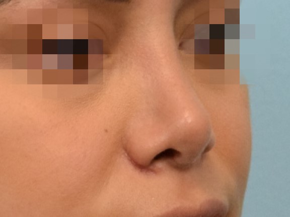 Revision Rhinoplasty Before & After Image