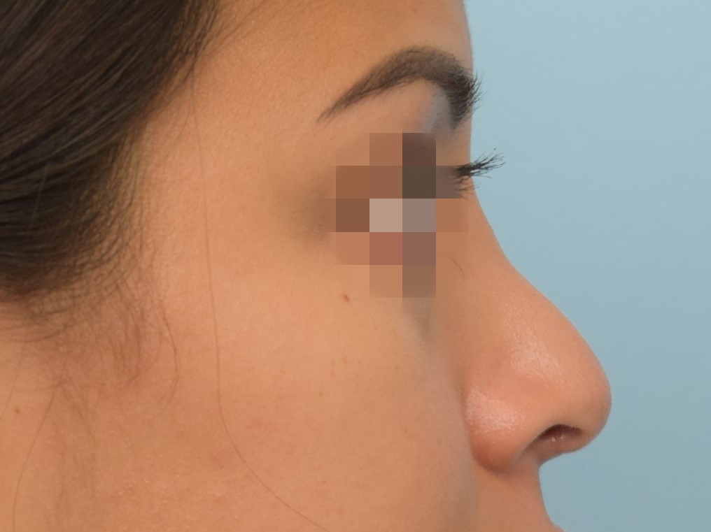 Revision Rhinoplasty Before & After Image