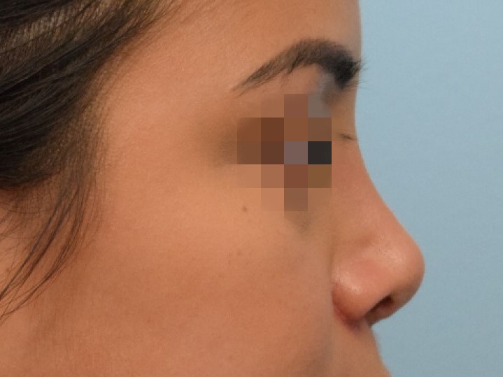 Revision Rhinoplasty Before & After Image