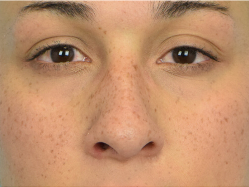 Revision Rhinoplasty Before & After Image