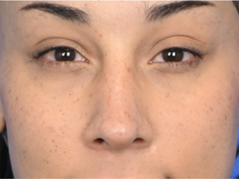 Revision Rhinoplasty Before & After Image