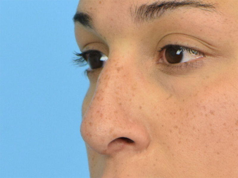 Revision Rhinoplasty Before & After Image