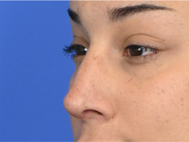 Revision Rhinoplasty Before & After Image