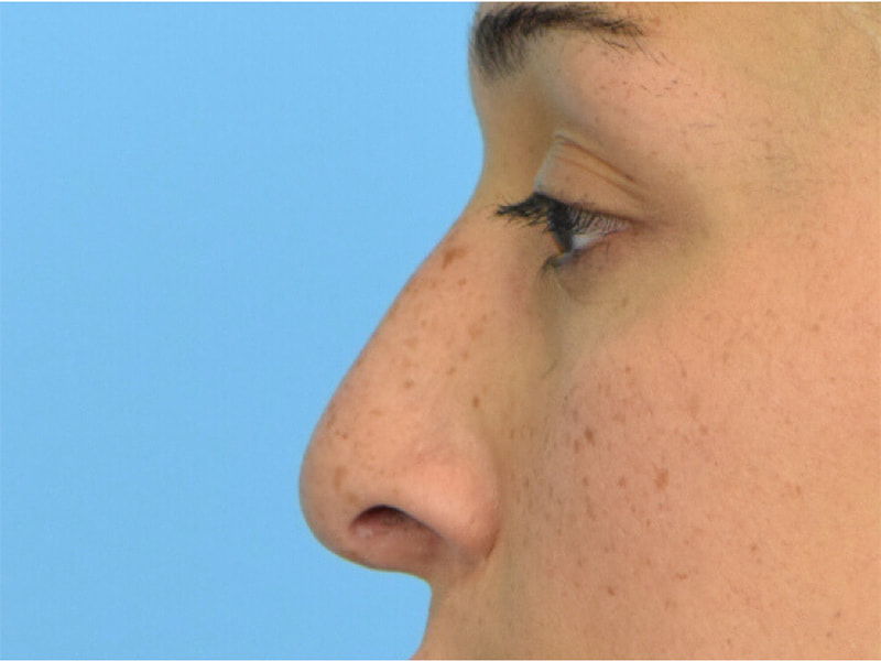 Revision Rhinoplasty Before & After Image