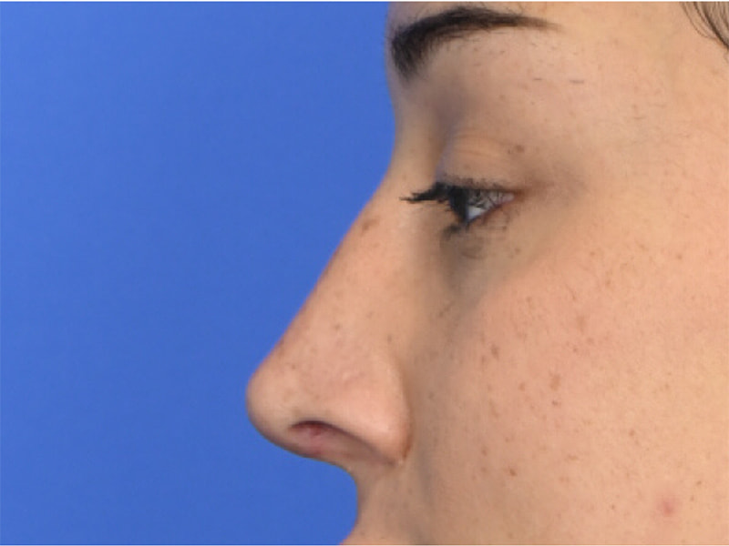 Revision Rhinoplasty Before & After Image