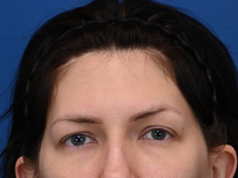 Revision Rhinoplasty Before & After Image