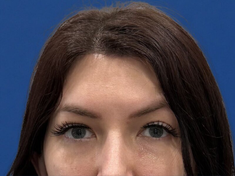 Revision Rhinoplasty Before & After Image