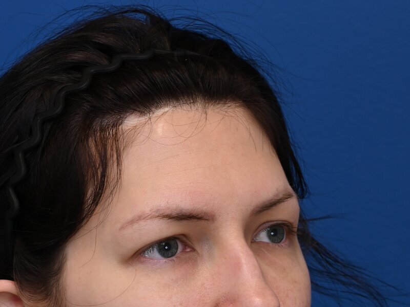 Revision Rhinoplasty Before & After Image