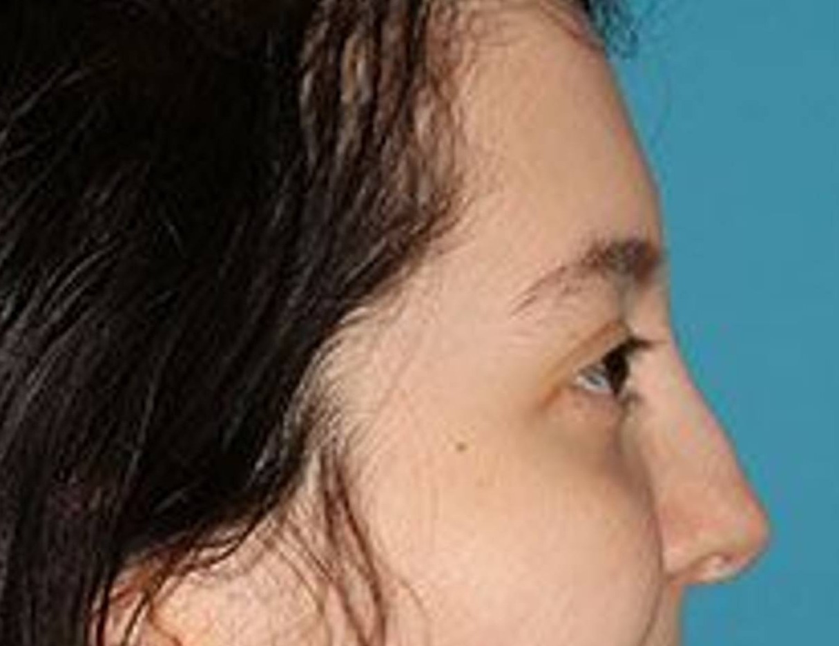 Rhinoplasty Before & After Image