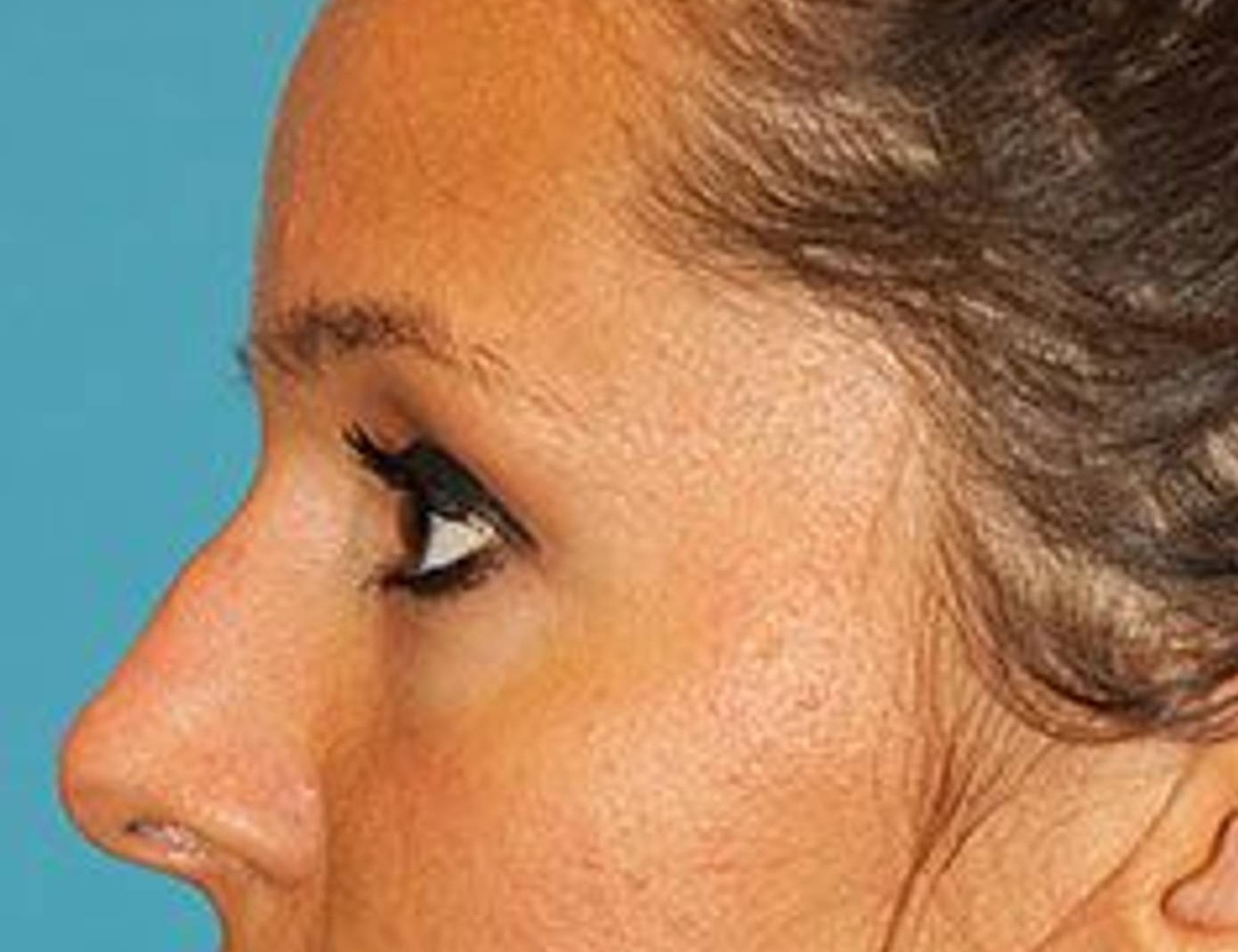 Rhinoplasty Before & After Image