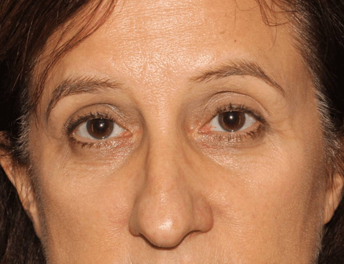 Rhinoplasty Before & After Image