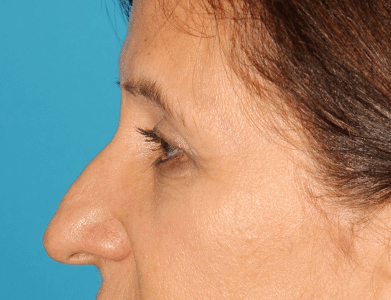 Rhinoplasty Before & After Image