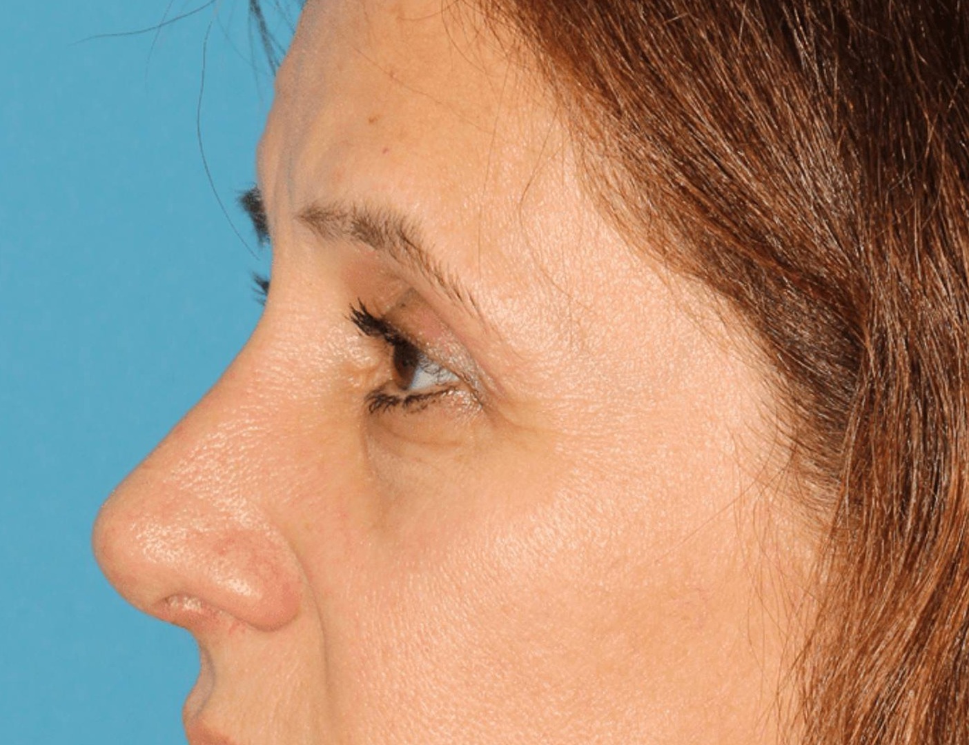 Rhinoplasty Before & After Image