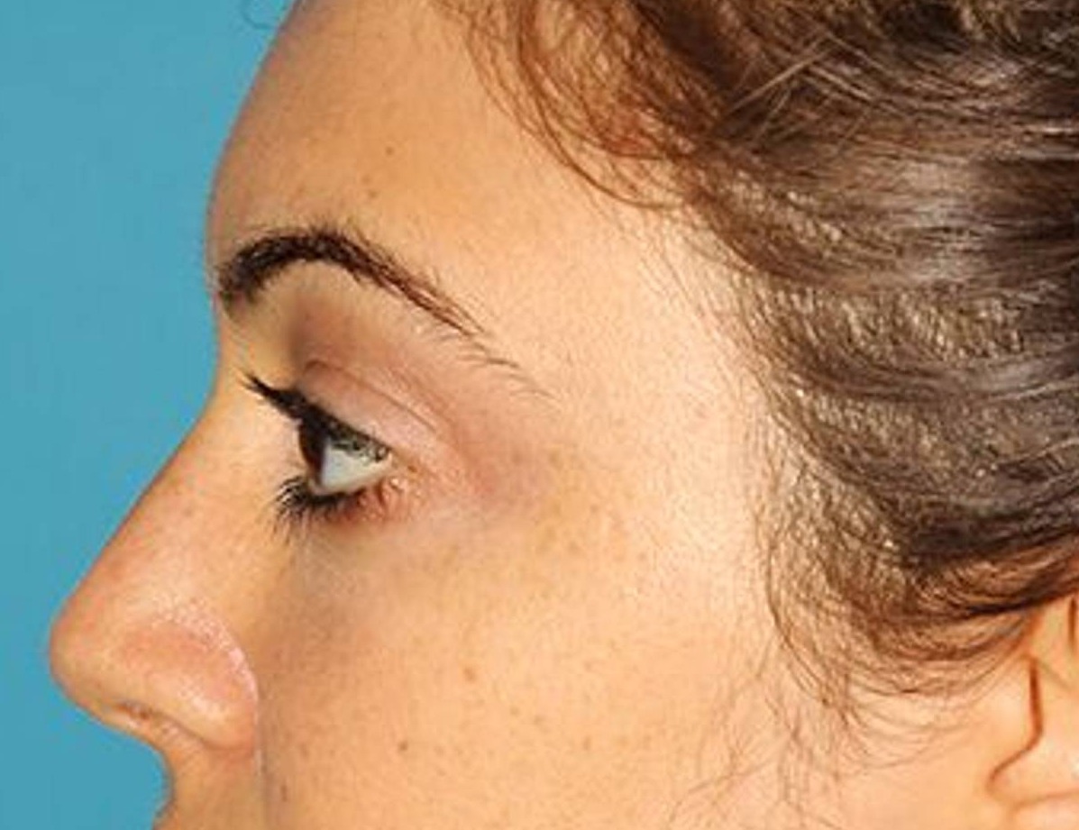 Rhinoplasty Before & After Image