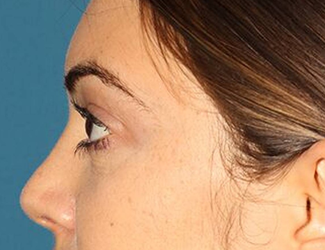 Rhinoplasty Before & After Image